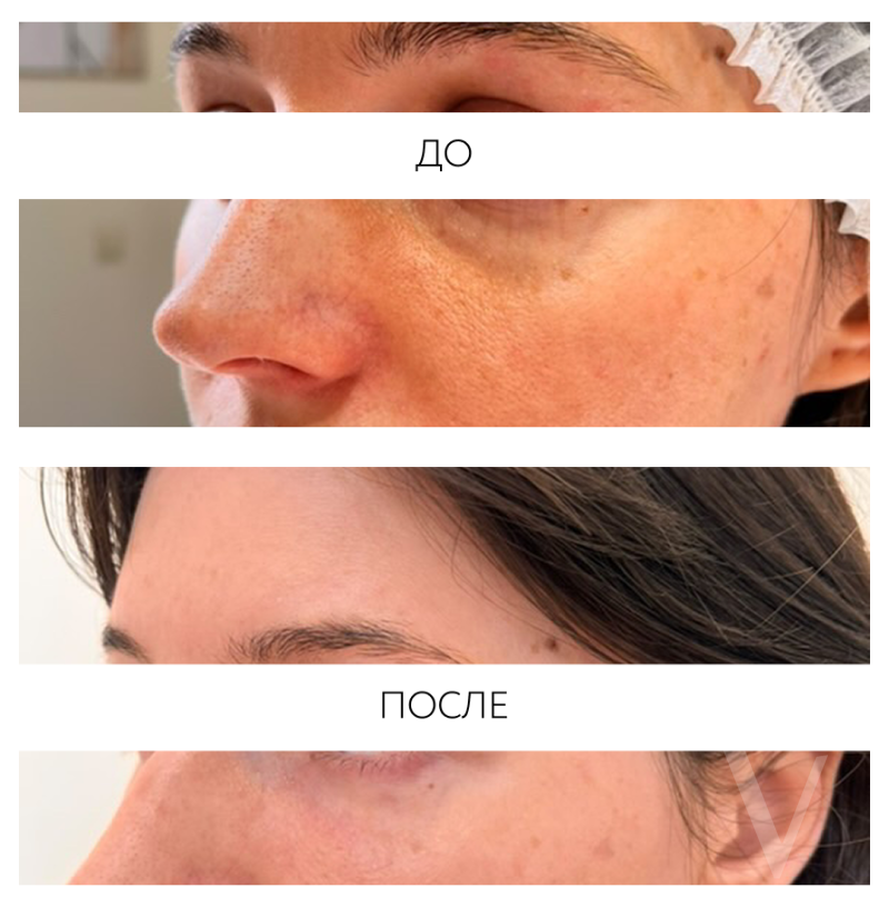 Сферогель – результат до и после. Фото 768. Доктор Асмик Карапетян. Отзыв о препарате Сферогель