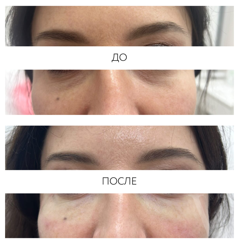 Сферогель – результат до и после. Фото 771. Доктор Наталья Шукюрова. Отзыв о препарате Сферогель