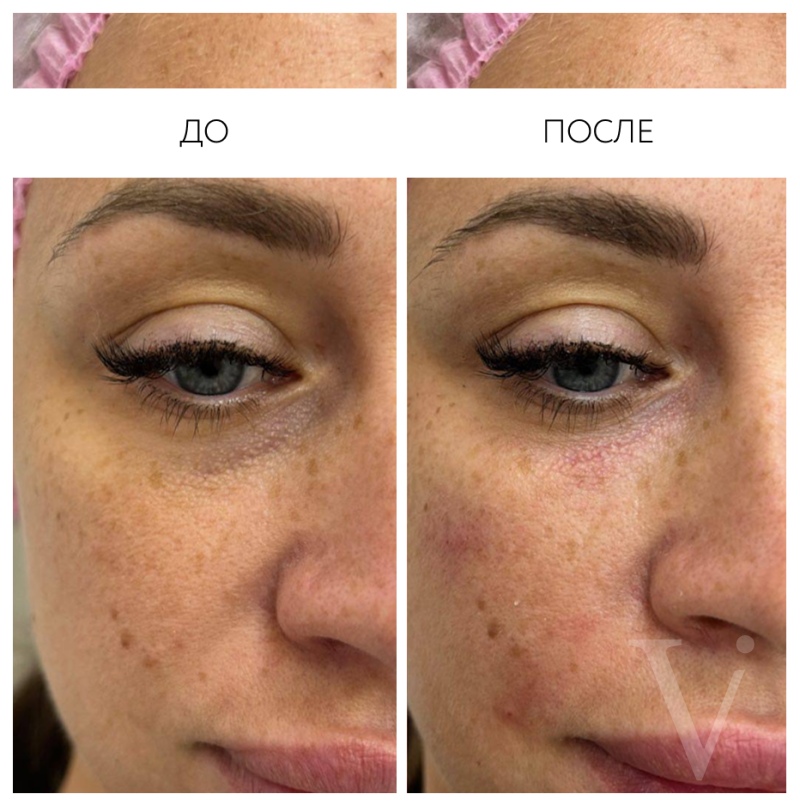 Сферогель – результат до и после. Фото 767. Доктор Наталья Шукюрова. Отзыв о препарате Сферогель